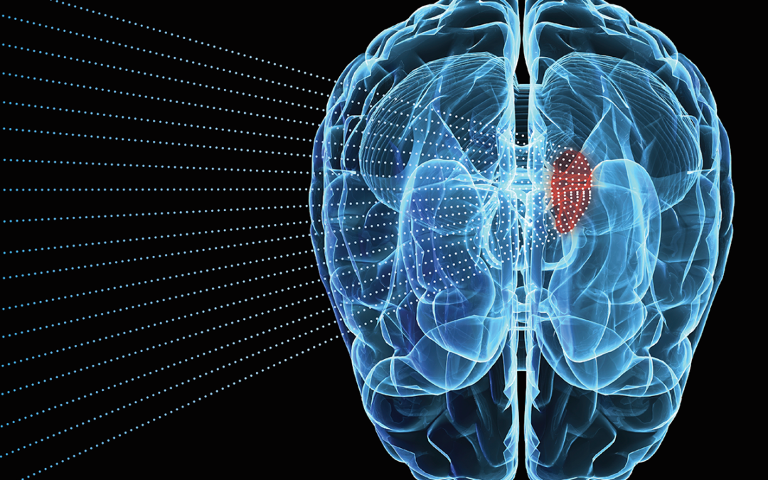 Revolutionary Sonodynamic Therapy Offers Hope In Glioblastoma Battle ...